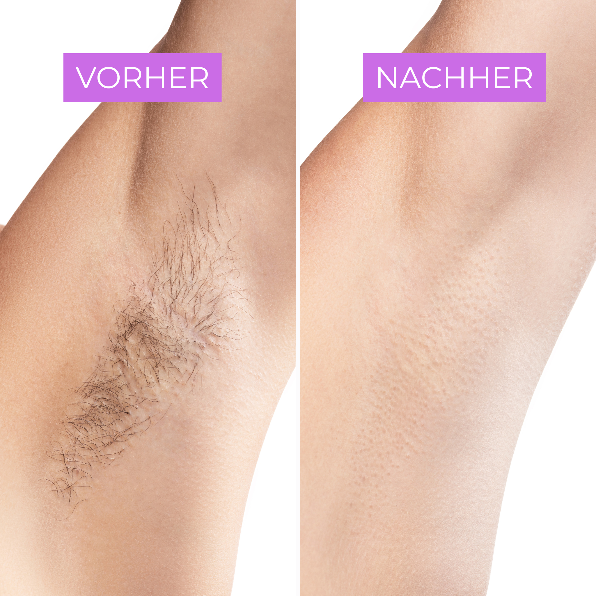 Crystal hair remover