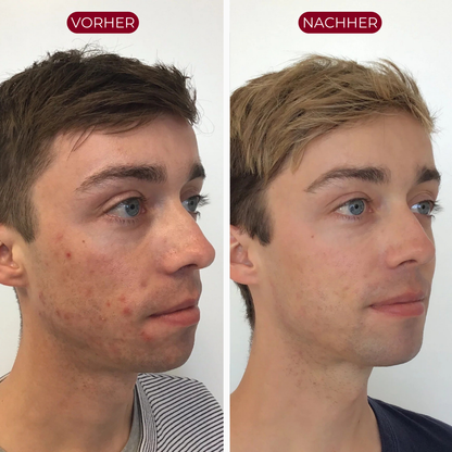 PureSkin™ Serum Duo | Men Edition
