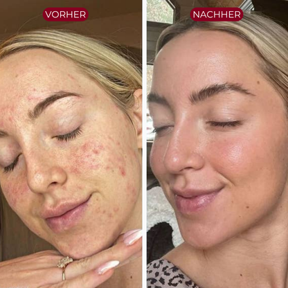 PureSkin™ Peeling Serum (Schwarzer Reis)