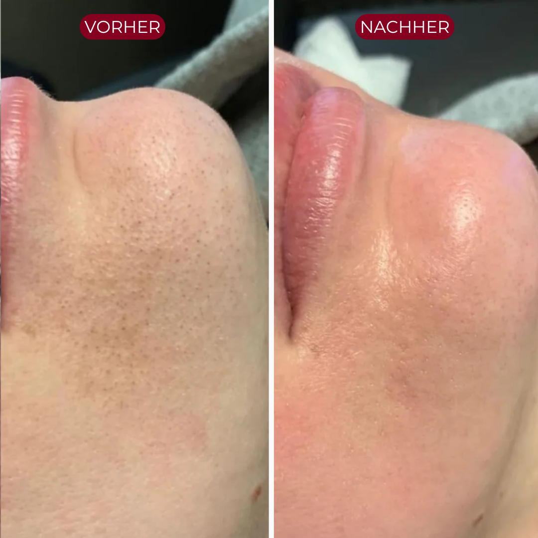 PureSkin™ Peeling Serum (Schwarzer Reis)