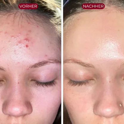 PureSkin™ Peeling Serum (Schwarzer Reis)