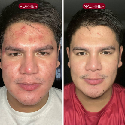PureSkin™ Serum Duo | Men Edition