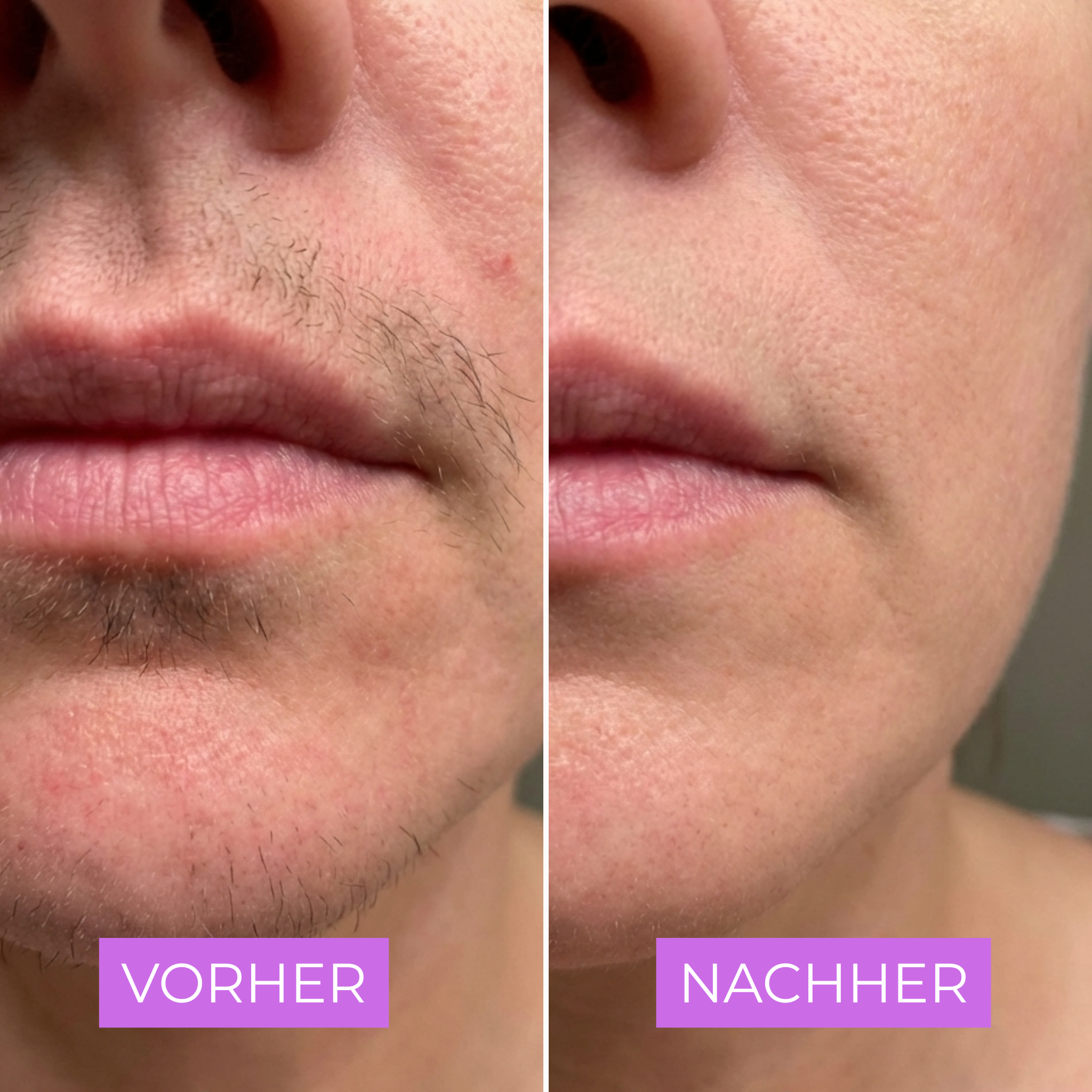 Cyperin Anti-Haar Serum